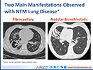 2017 Nontuberculous Mycobacterial Lung Disease Today and Tomorrow